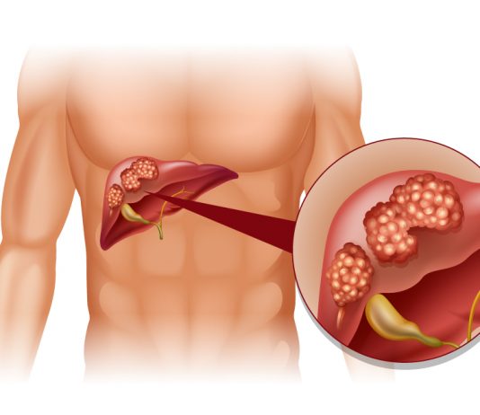 Nouveaux horizons pour le carcinome hépatocellulaire