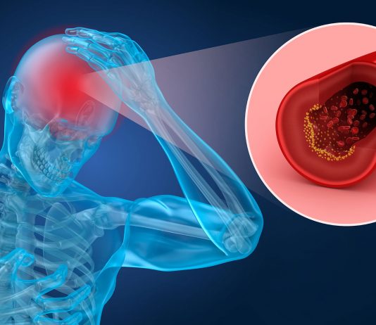 AVC et FA, le couple infernal