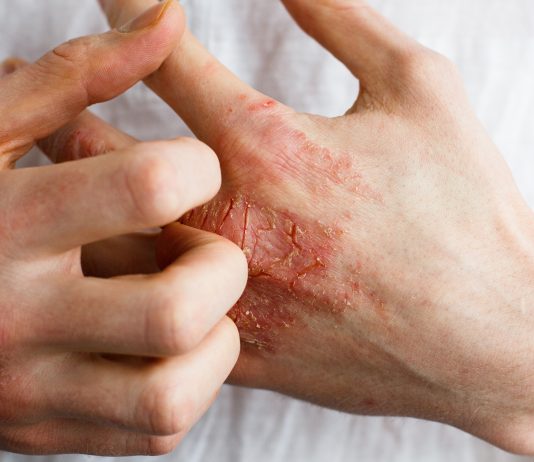 Dermatite atopique : la révolution thérapeutique