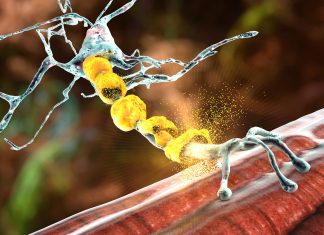 Un tournant majeur dans la prise en charge de la sclérose en plaques (SEP)