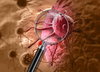 Cancer – Un modèle économique à adapter