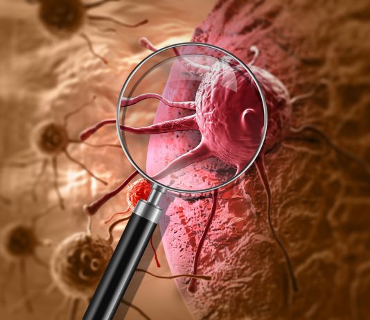 Cancer – Un modèle économique à adapter