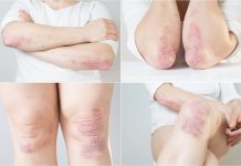 Dermatologie : des progrès majeurs