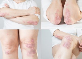 Dermatologie : des progrès majeurs