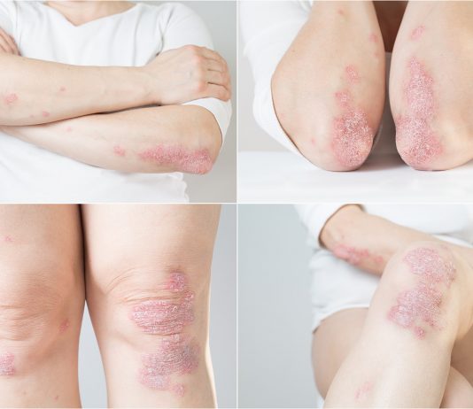 Dermatologie : des progrès majeurs