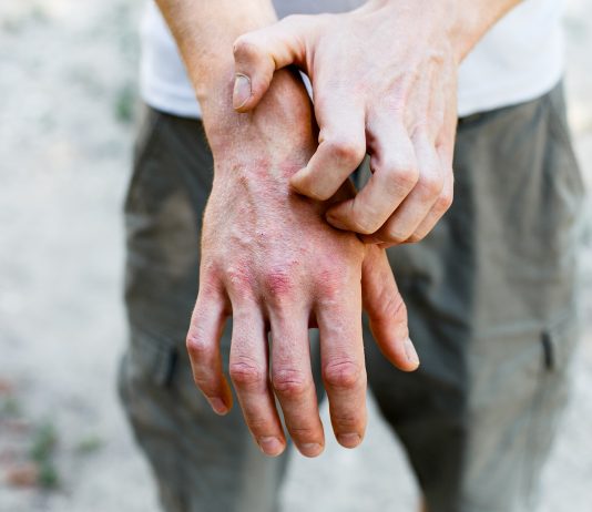 Dermatologie : de nouveaux espoirs pour les patients