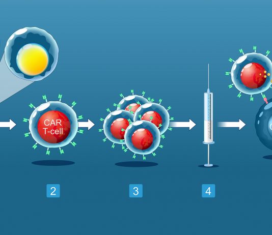 Thérapie cellulaire CAR-T : enfin une solution pour les patients en rechute