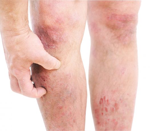 Dermatologie : des avancées porteuses d’espoir