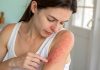 Dermatologie : ensemble, faire entendre la voix des patients Woman examining red rash on arm skin irritation allergy reaction