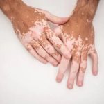 Vitiligo : sortir de la dénégation, entrer dans l’espoir