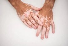 Vitiligo : sortir de la dénégation, entrer dans l’espoir