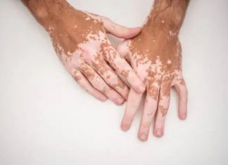 Vitiligo : sortir de la dénégation, entrer dans l’espoir